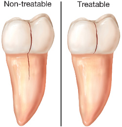 Cracked Teeth
