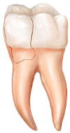 Cracked Teeth