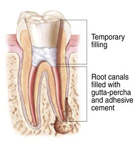 Non-Surgical Root Canal Treatment