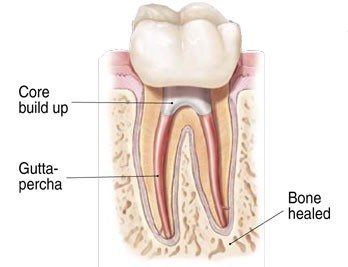 Non-Surgical Root Canal Treatment