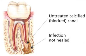 Non-Surgical Retreatment