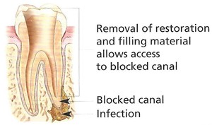 Non-Surgical Retreatment