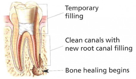 Non-Surgical Retreatment