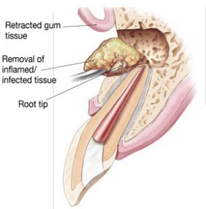 Endodontic Surgery (Apicoectomy)